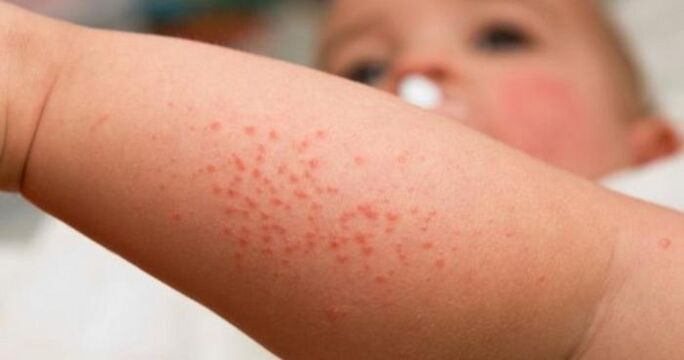 Erupción cutánea como síntoma de una infección parasitaria.